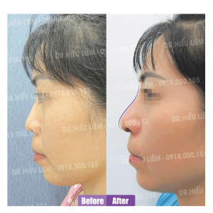 Nâng mũi bác sĩ Hiếu Liêm quận 10 có đẹp không