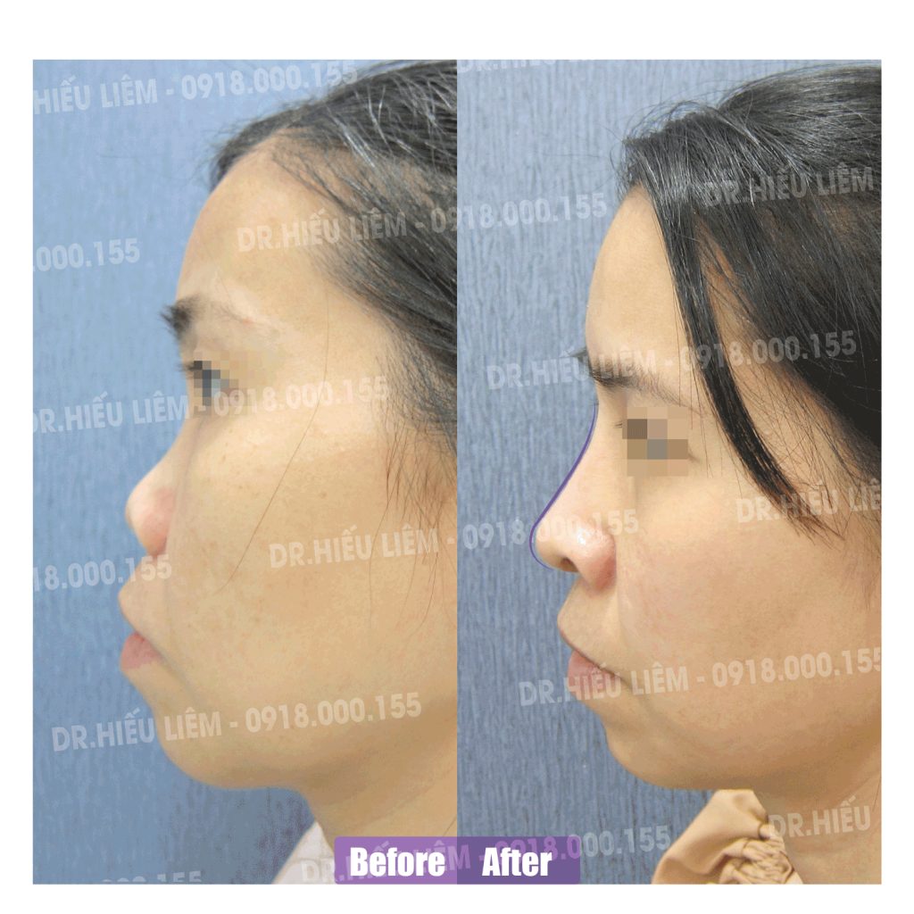 Nâng mũi cấu trúc bác sĩ Hiếu Liêm quận 10 đẹp không - mũi ngắn hếch