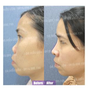 Nâng mũi cấu trúc bác sĩ Hiếu Liêm quận 10 đẹp không - mũi ngắn hếch