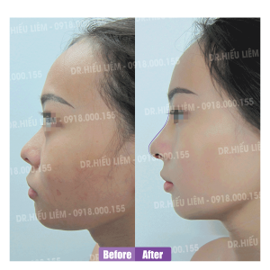 Nâng mũi cấu trúc bác sĩ Hiếu Liêm quận 10 đẹp không