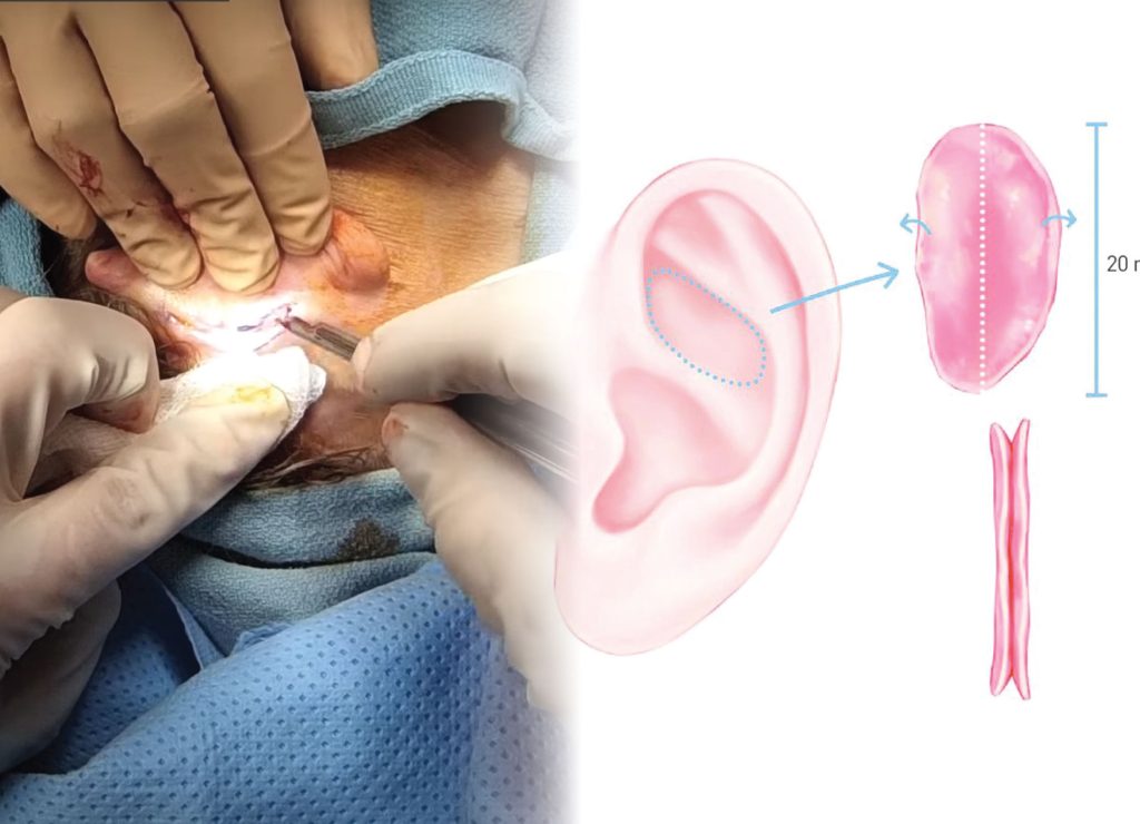 Nâng mũi cấu trúc xong phải sửa lại vì quy trình lấy sụn tự thân - Bác sĩ Hiếu Liêm quận 10