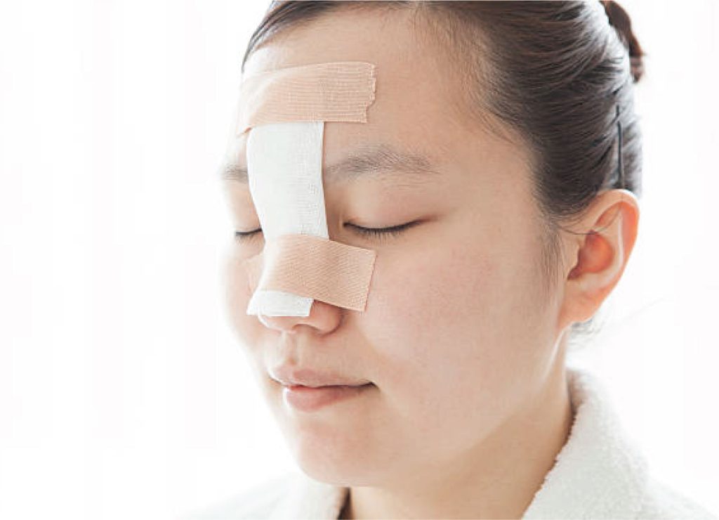 Nâng mũi cấu trúc xong phải sửa lại vì chăm sóc không tốt - Bác sĩ Hiếu Liêm quận 10
