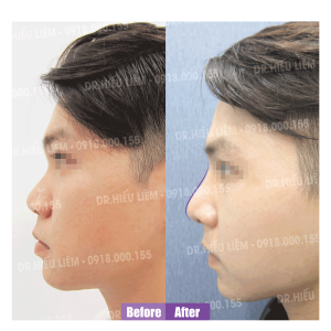 Review khách hàng nâng mũi cấu trúc bác sĩ Hiếu Liêm quận 10 - Mr Quang