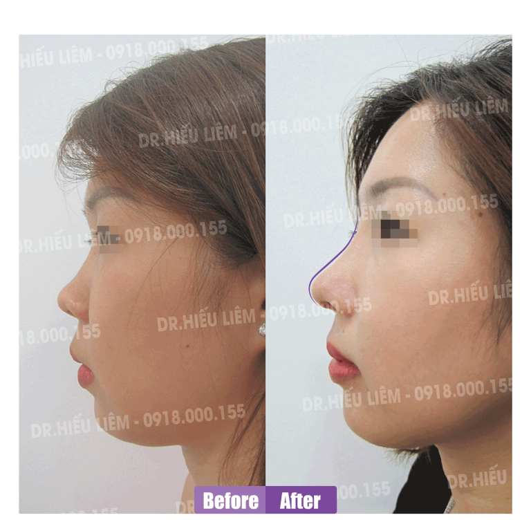 Review khách hàng nâng mũi cấu trúc bác sĩ Liêm quận 10 khắc phục mũi ngắn sóng mũi thấp