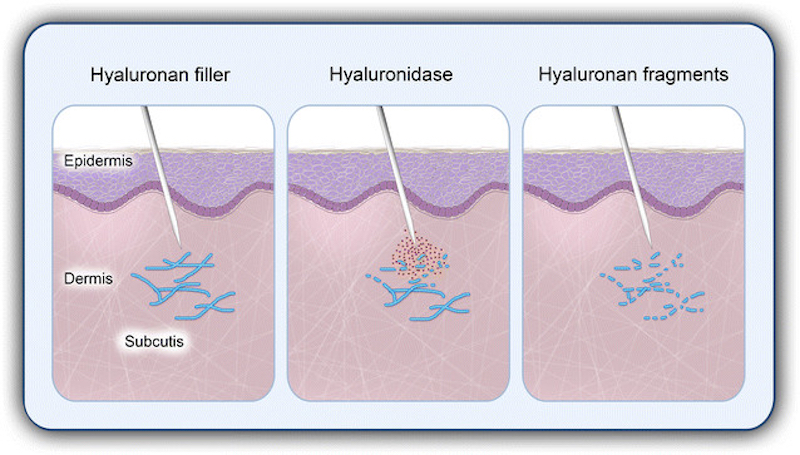 Hyaluronidase dùng trong tiêm tan môi có an toàn không - Bác sĩ Hiếu Liêm quận 10