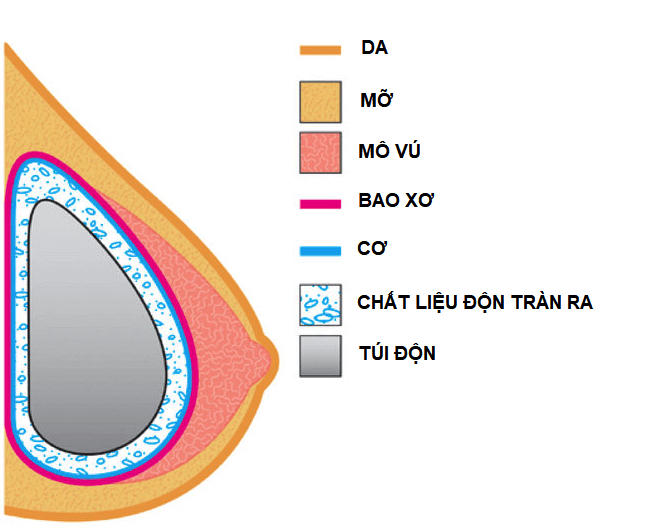 Bao xơ co thắt nâng ngực là gì - Bác sĩ Hiếu Liêm quận 10