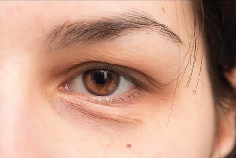 Cấy mỡ tự thân khắc phục hốc mắt sâu , trũng lệ - Dr Hiếu Liêm quận 10