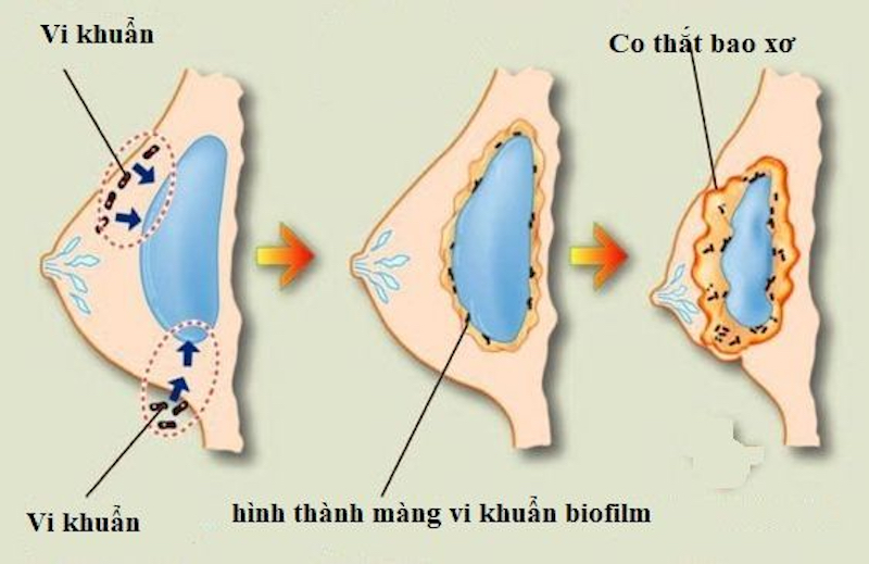 Có thắt bao xơ sau nâng ngực do nhiễm trùng - Bác sĩ Hiếu Liêm quận 10