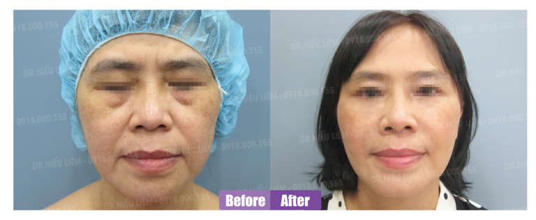 Khách hàng căng da thái dương, cấy mỡ tự thân và tiêm PRP - Dr Hiếu Liêm quận 10
