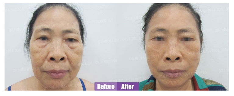 Khách hàng trẻ hóa khuôn mặt với dịch vụ căng da và cấy mỡ mặt - Dr Hiếu Liêm quận 10