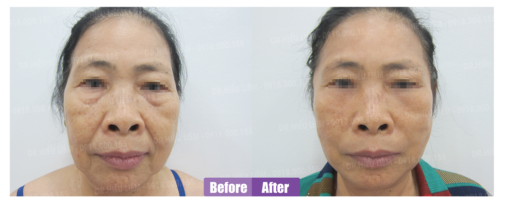 Khách hàng trẻ hóa khuôn mặt với dịch vụ căng da và cấy mỡ mặt - Dr Hiếu Liêm quận 10