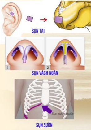 Nâng mũi sụn tự thân hay sụn surgiform tốt hơn - Bác sĩ Hiếu Liêm