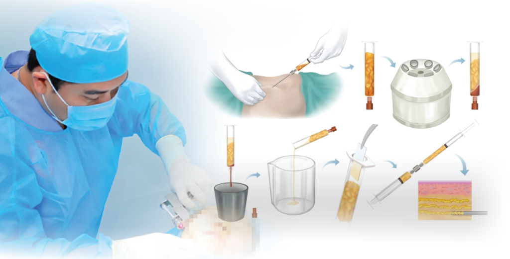 Quy trình cấy mỡ tự thân trẻ hóa - Bác sĩ Hiếu Liêm quận 10