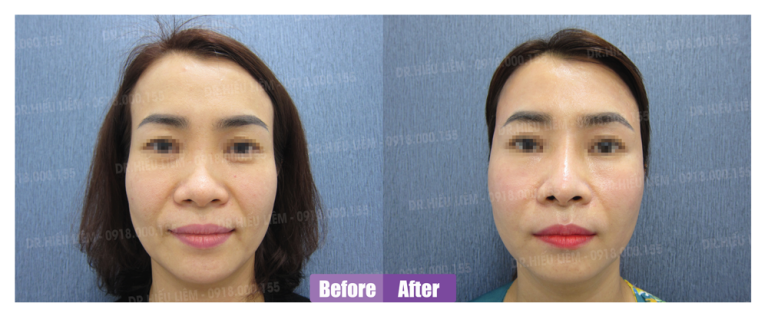 Review trẻ hoá căng da cấy mỡ mặt - Dr Hiếu Liêm quận 10