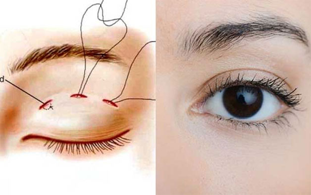 Chỉ dùng để nhấn mí có tự tiêu - Bác sĩ Hiếu Liêm quận 10
