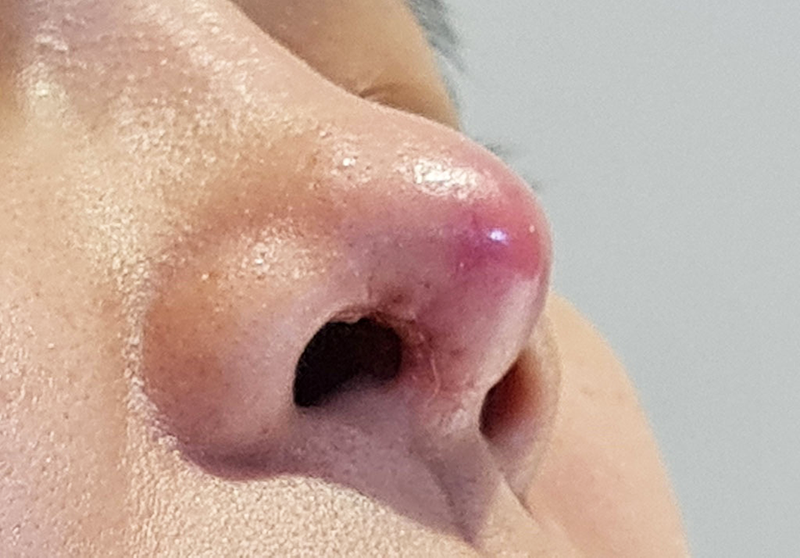 Đầu mũi đỏ sau nâng mũi phải làm sao - Bác sĩ Hiếu Liêm quận 10