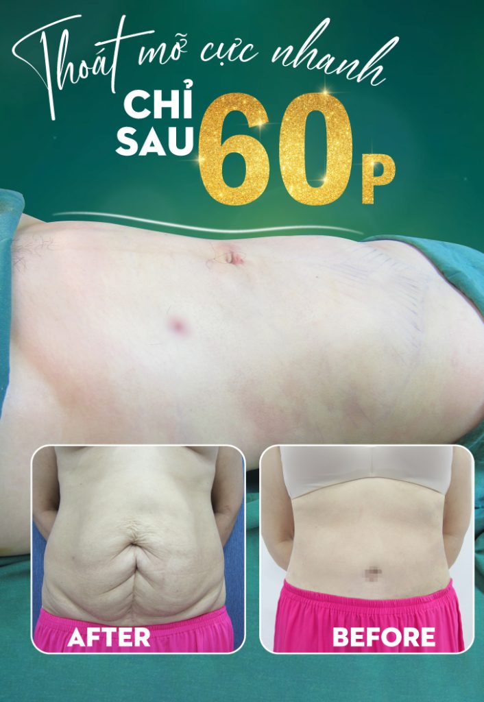 Hút mỡ bụng sau sinh an toàn hiêu quả - Bác sĩ Hiếu Liêm quân 10