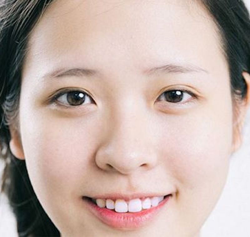 Mí mắt không đều khắc phục như thế nào - Bác sĩ nhấn mí đẹp Dr Hiếu Liêm