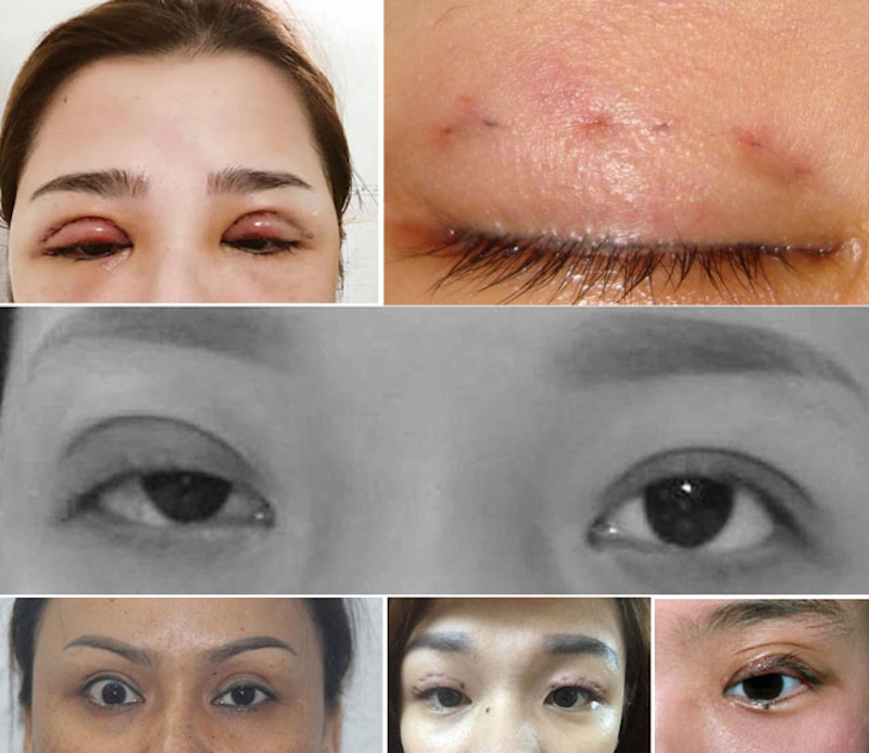 Nguy hiểm nhấn mí tại thẩm mỹ không uy tín - Bác sĩ Hiếu Liêm quận 10