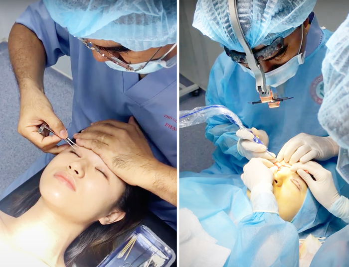 Nhấn mí nguy hiểm hay an toàn - Bác sĩ Hiếu Liêm quận 10