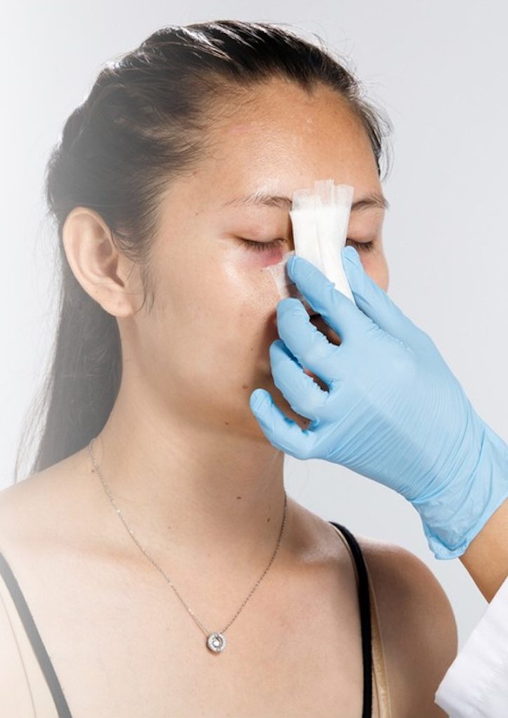 Phát hiện biến chứng nâng mũi bị chảy máu - Bác sĩ Hiếu Liêm quận 10
