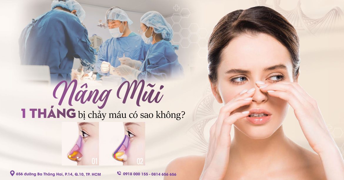 Sau khi nâng mũi 1 tháng bị chảy máu phải làm sao - Bác sĩ làm mũi uy tín Hiếu Liêm quận 10