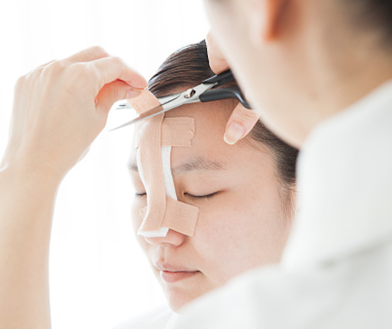 Sửa mũi 1 tháng bị chảy máu xử lý thế nào - Bác sĩ Hiếu Liêm quận 10