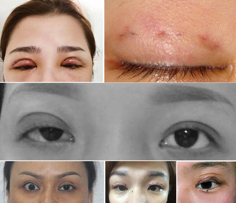 Tháo chỉ nhấn mí khi nhấn mí lỗi - Bác sĩ Hiếu Liêm quận 10