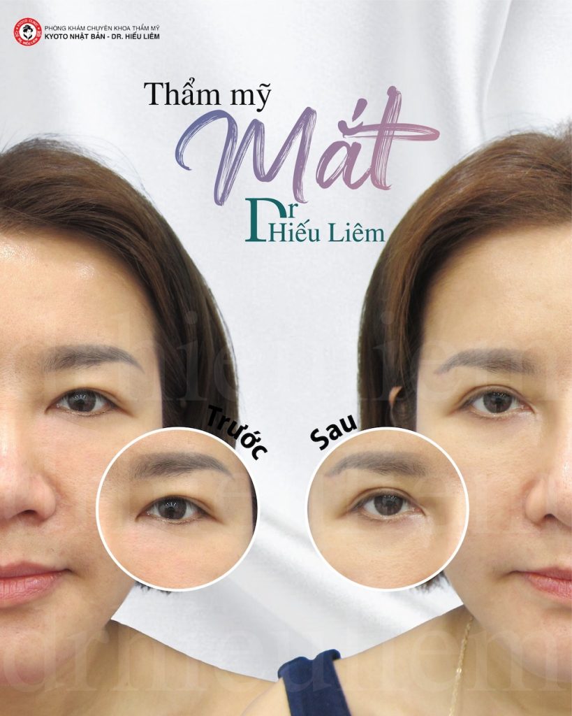 Bấm mí cho mắt 2 mí đẹp quận 10 - Dr Hiếu Liêm