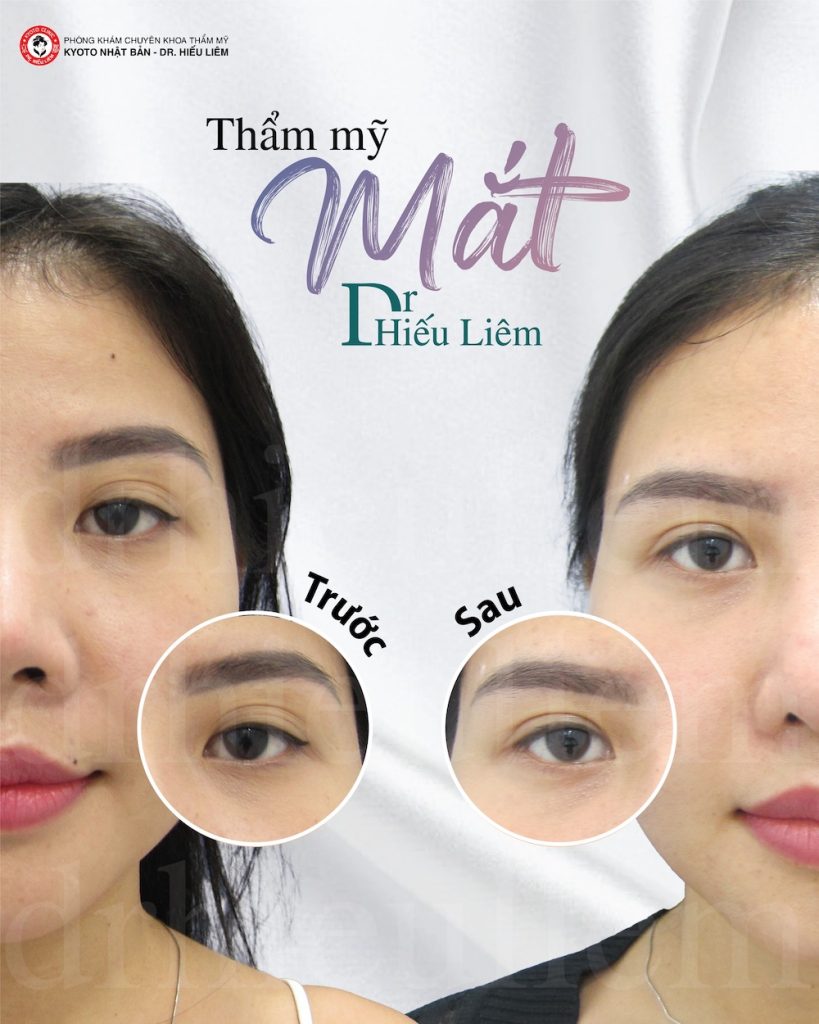 Mắt 2 mí sẵn nhấn mí được không - Bác sĩ bấm mí đẹp Dr Hiếu Liêm quận 10