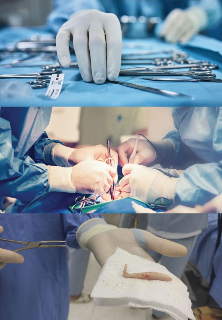 Nguyên nhân gây biến chứng sau nâng mũi - Bác sĩ sửa mũi hỏng uy tín - Drhieuliem