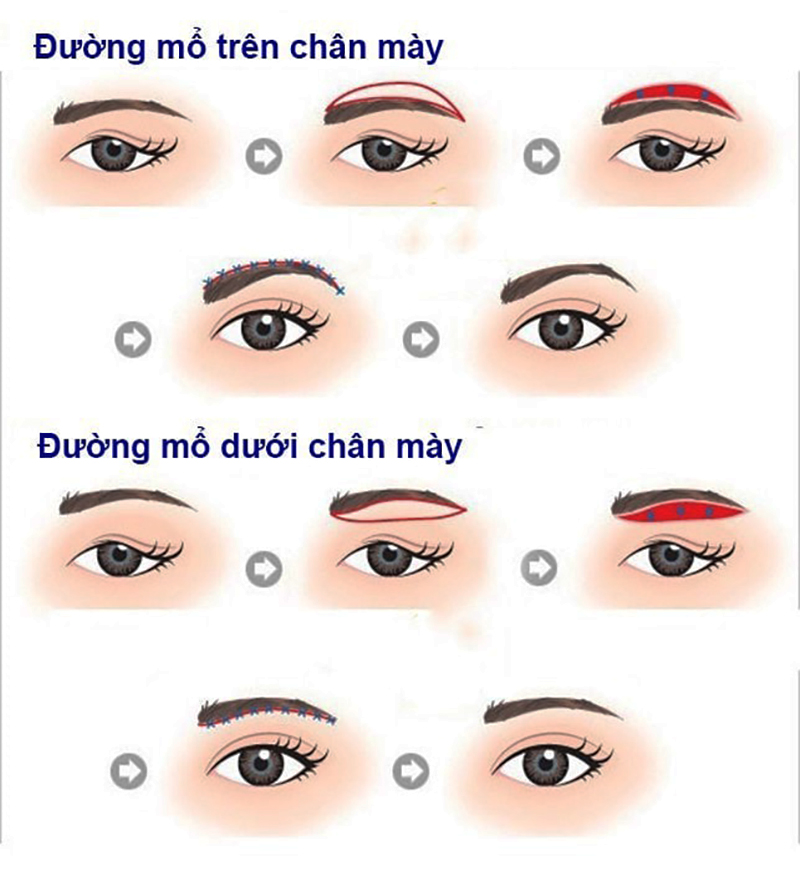 Ưu và nhược điểm của treo cung chân mày - bác sĩ nâng cung mày uy tín quận 10 - Dr Hiếu Liêm