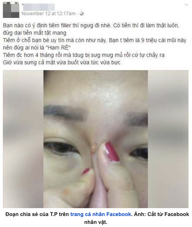 Biến chứng tràn filler có nguy hiểm không - Bác sĩ Hiếu Liêm quận 10