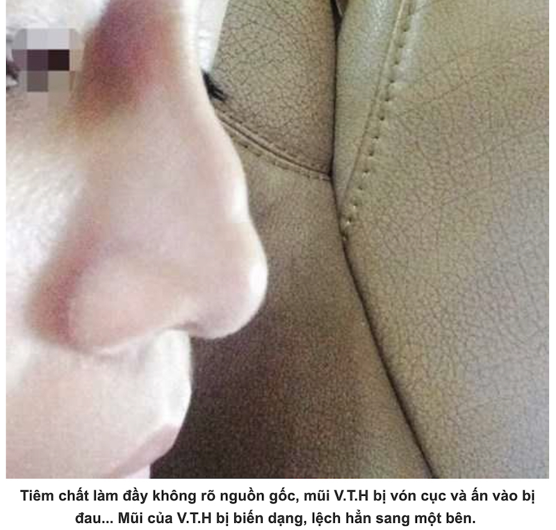 Biến chứng tràn filler vì thẩm mỹ chui - Bác sĩ Hiếu Liêm quận 10