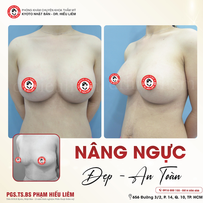 Khách hàng nâng ngực tại thẩm mỹ Kyoto - Dr.Hiếu Liêm Q.10