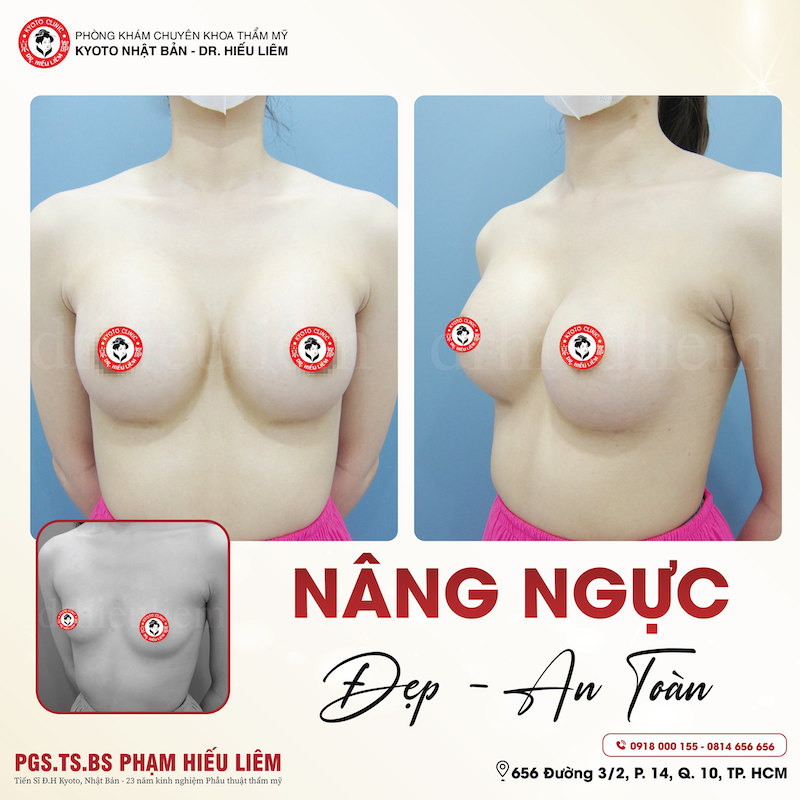 Khách hàng nâng ngực tại thẩm mỹ Kyoto - Dr.Hiếu Liêm Q.10