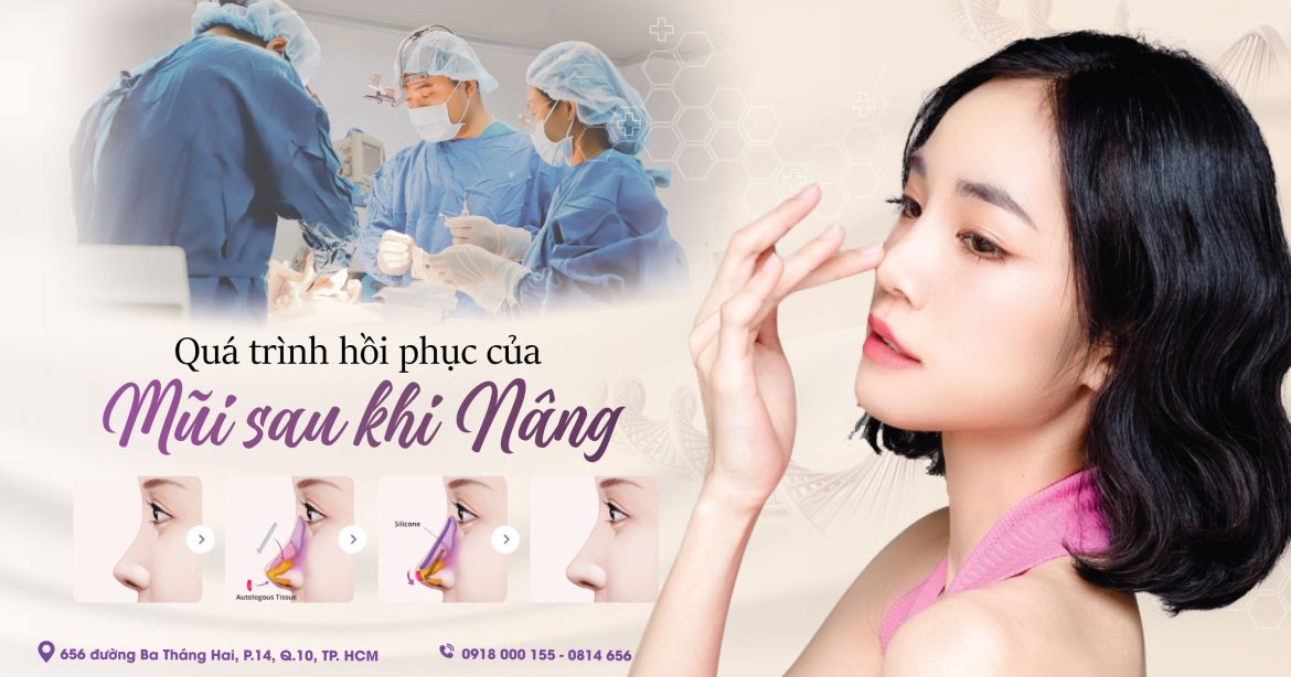 Mũi sau khi nâng bao lâu hồi phục - Bác sĩ nâng mũi đẹp quận 10 - Dr Hiếu Liêm