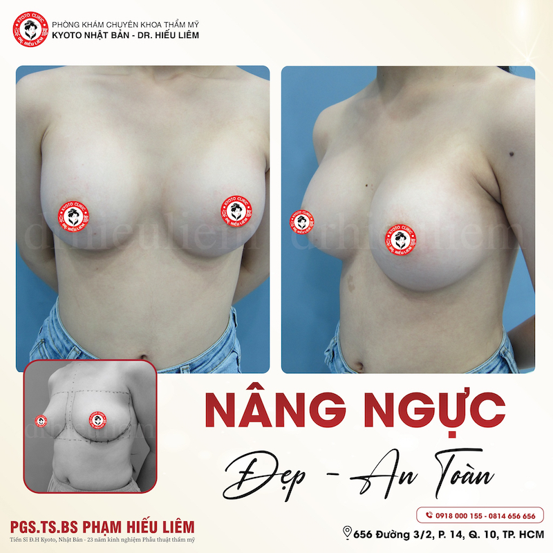 Khách hàng nâng ngực tại thẩm mỹ Kyoto - Dr.Hiếu Liêm Q.10