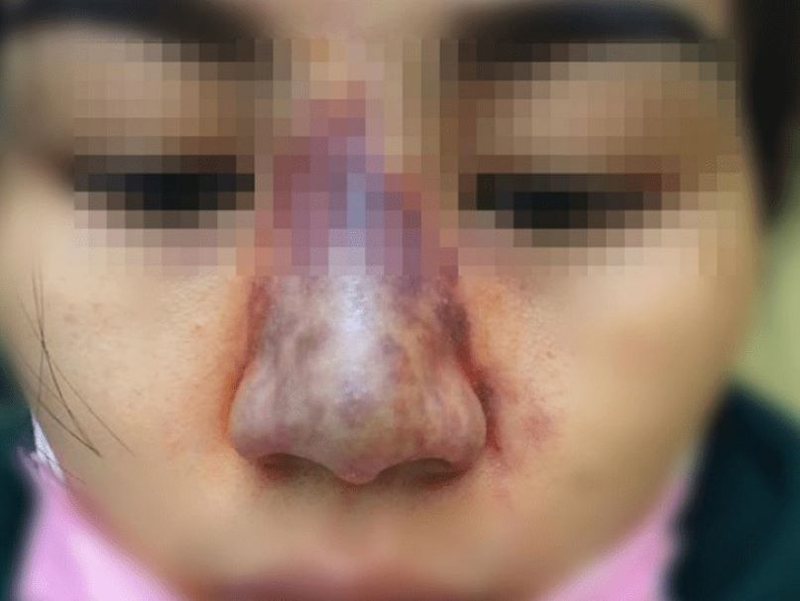 Tiêm filler bị tràn điều trị được không - Bác sĩ Hiếu Liêm quận 10