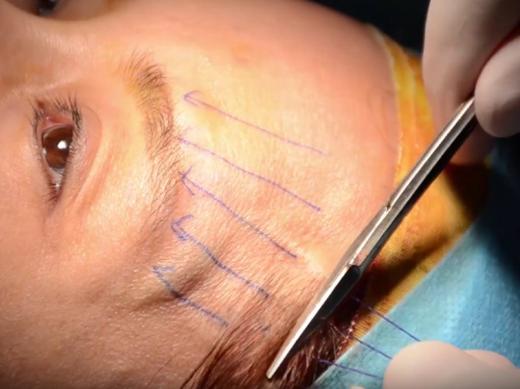 Ưu và nhược điểm của treo cung chân mày - bác sĩ nâng cung mày uy tín quận 10 - Dr Hiếu Liêm
