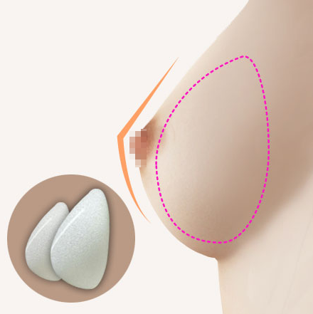 Nâng ngực túi giọt nước-Dr.Hiếu Liêm Q.10