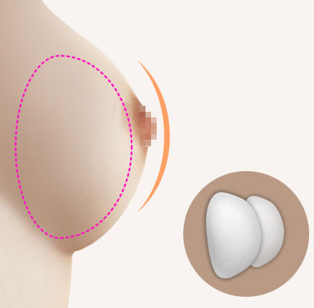 Nâng ngực túi trơn-Dr.Hiếu Liêm Q.10