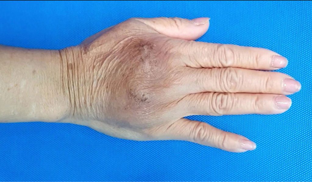 Phương pháp trẻ hoá bàn tay-tiêm mỡ tự thân-Dr.Hiếu Liêm