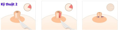 Thu gọn đầu ti kỹ thuật-Dr.Hiếu Liêm Q.10