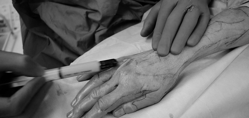 Phương pháp trẻ hoá bàn tay- tiêm mỡ tự thân-Dr.Hiếu Liêm