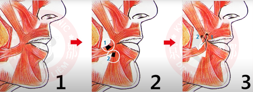 Tạo khoé môi cười - Phương pháp phẫu thuật- Dr.Hiếu Liêm Q10