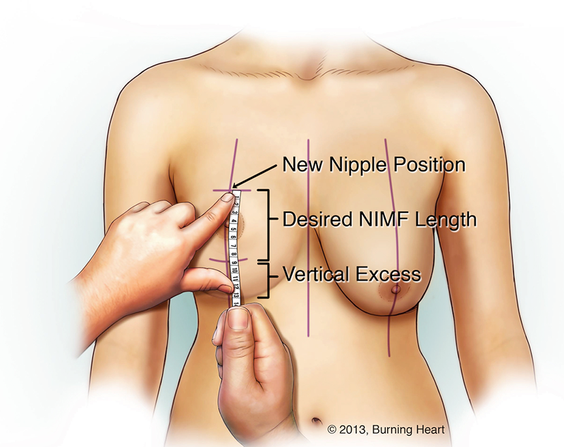 Treo ngực xệ có nguy hiểm không và thực hiện như thế nào - Dr.Hiếu Liêm Q.10