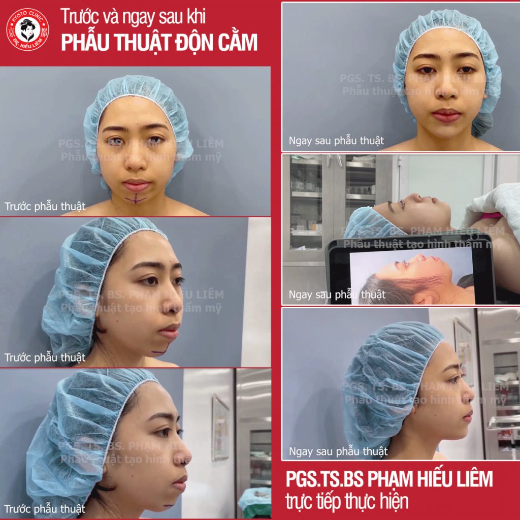 Hình ảnh khách hàng phẫu thuật độn cằm tại thẩm mỹ Kyoto- Dr.Hiếu Liêm Q.10