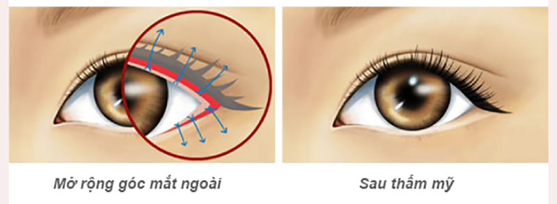 Mở góc mắt ngoài - Dr.Hiếu Liêm Q.10
