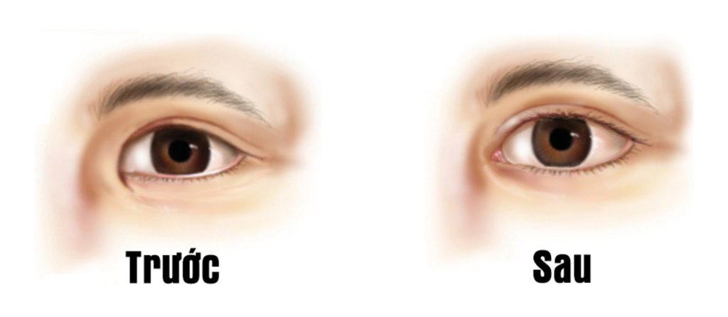 Thẩm mỹ mở góc mắt trong khắc phục mắt nếp rẻ quạt - Dr.Hiếu Liêm Q.10